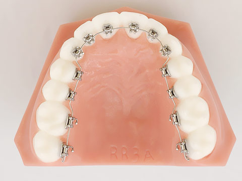 裏側矯正（見えない矯正）